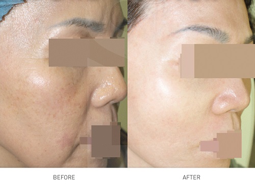 skin-pigmentation-laser-treatment-1