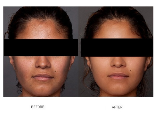 hydrate-meso-treatment-before-after