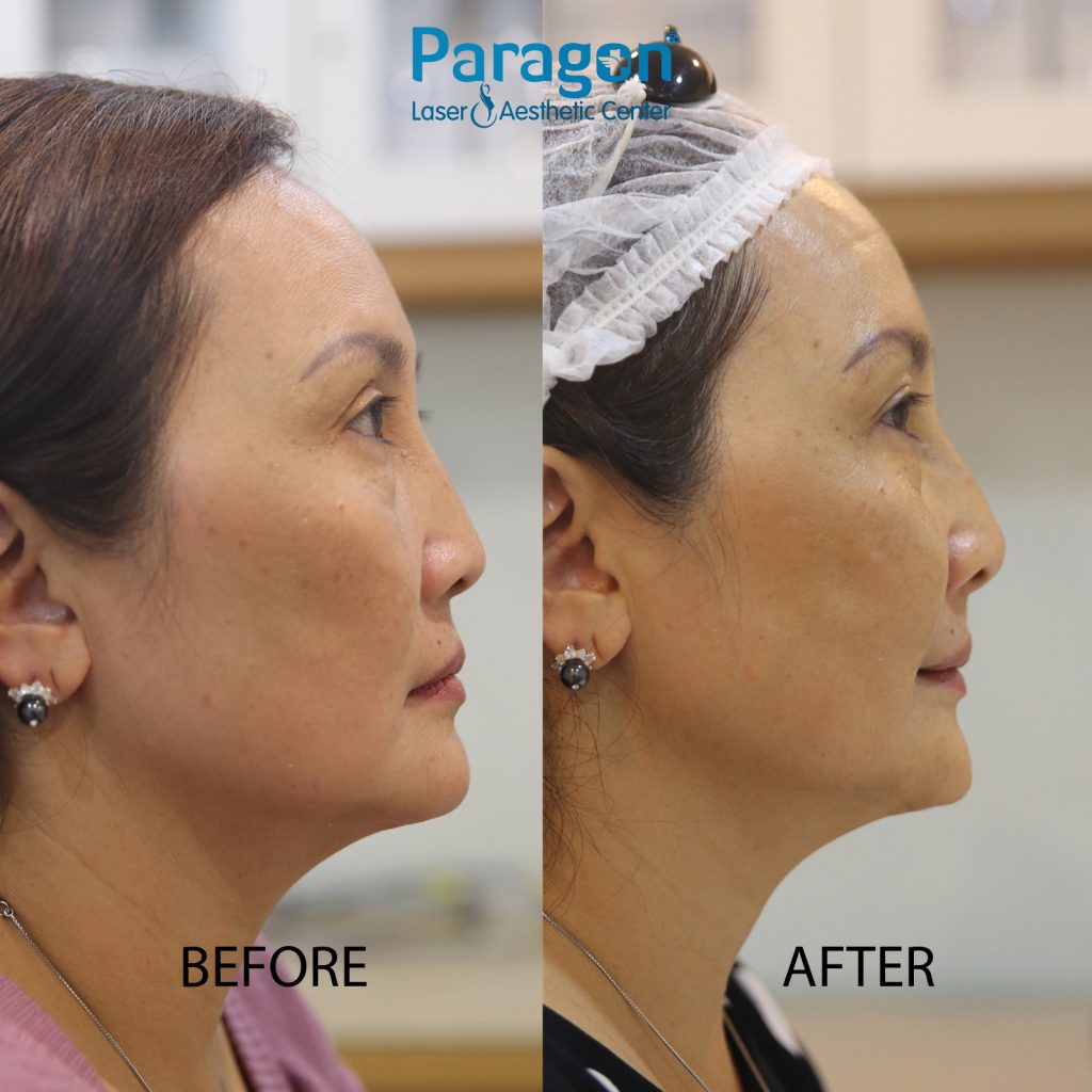 skin-booster-before-after-paragon-clinic