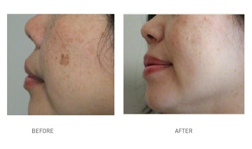 skin-pigmentation-laser-treatment-1