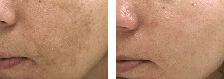 skin-pigmentation-laser-treatment