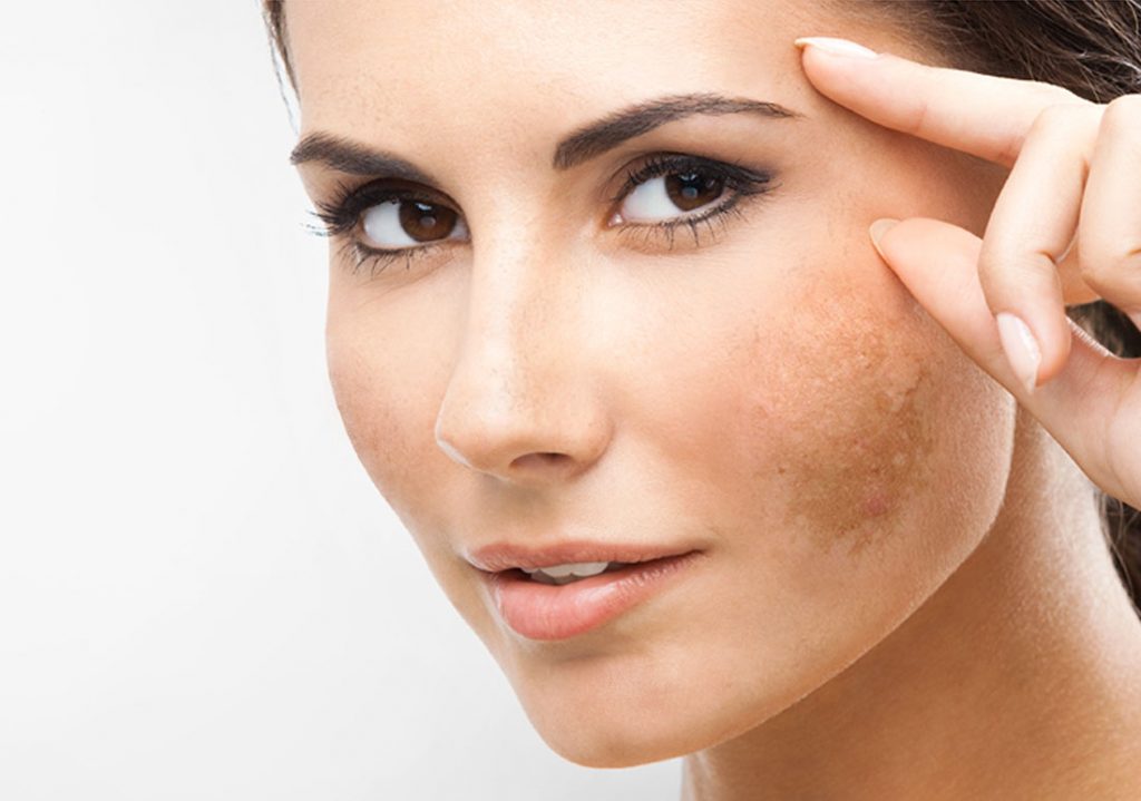 skin-pigmentation-laser-treatment-9