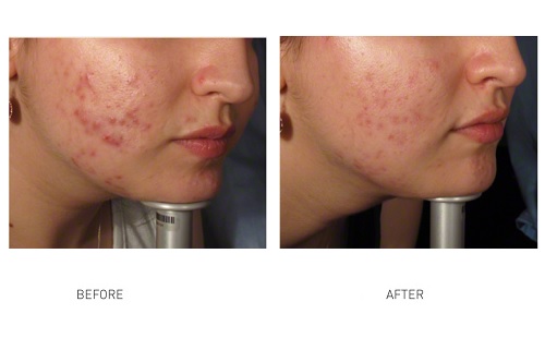 acne-removal-laser-paragon-clinic