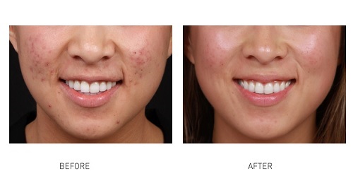 acne-removal-laser-paragon-clinic