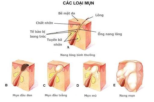 cac-loai-mun-acne-removal-laser-paragon-clinic
