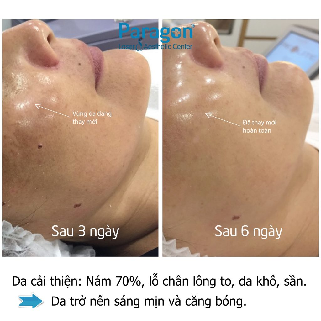 paragonclinic-before-after-skin-booster (2)