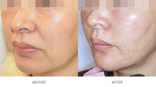 tetra-lifting-laser-before-after-xoa-nhan-paragon-clinic