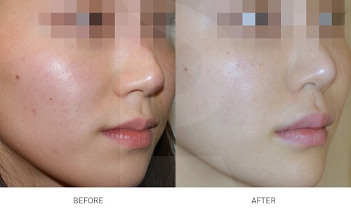 tetra-lifting-laser-before-after-xoa-nhan-paragon-clinic