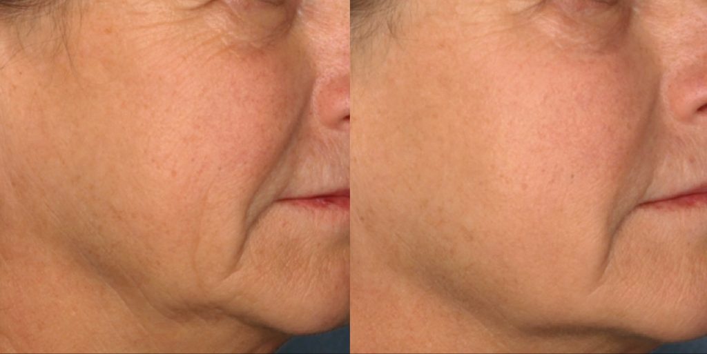 skin-rejuvenation-anti-aging-cooltouch-laser