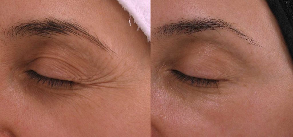 skin-rejuvenation-anti-aging-cooltouch-laser