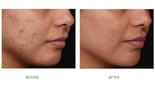 dpl-acne-treatment