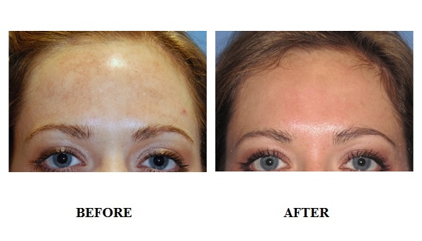 dpl-acne-treatment