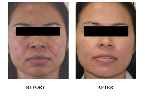 dpl-acne-treatment