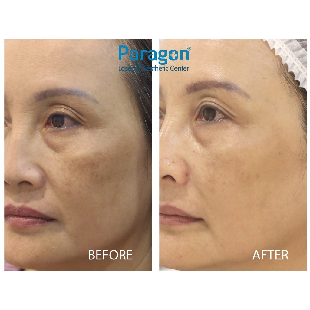 paragonclinic-before-after-skin-booster (1)