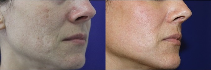 laser-resurfacing